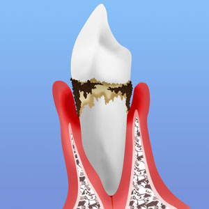 歯周病重度期